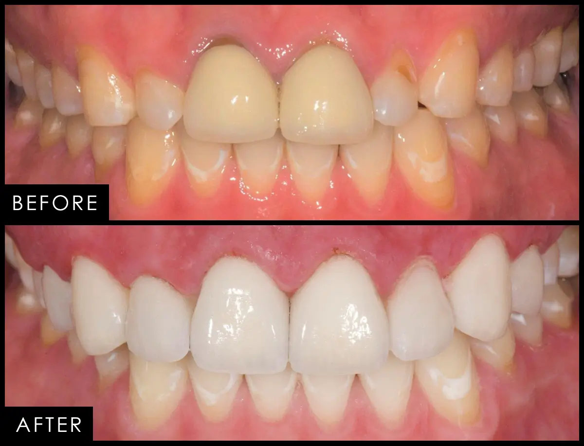 Before and after