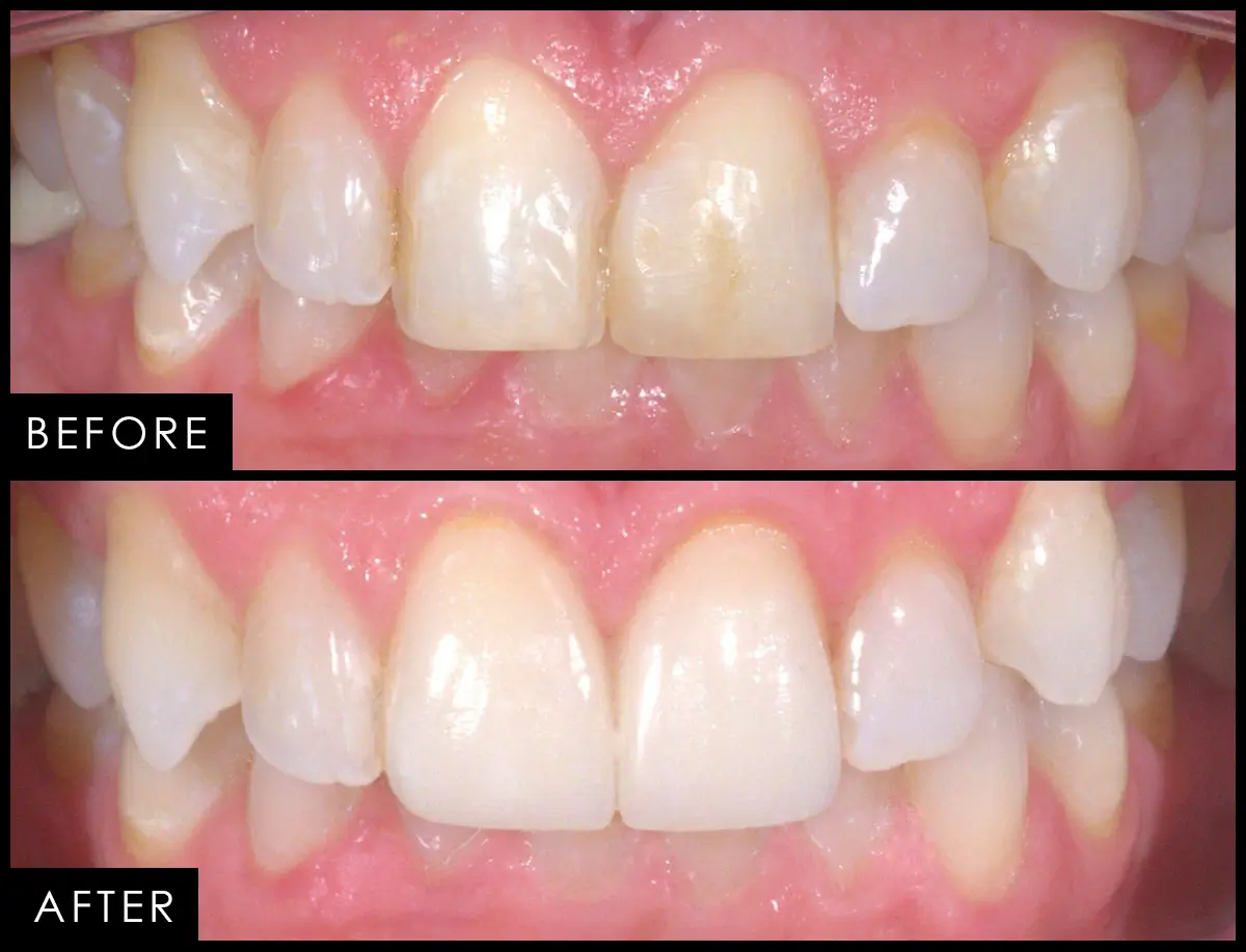 Before and after