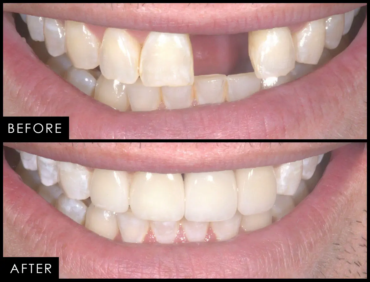 Before and after