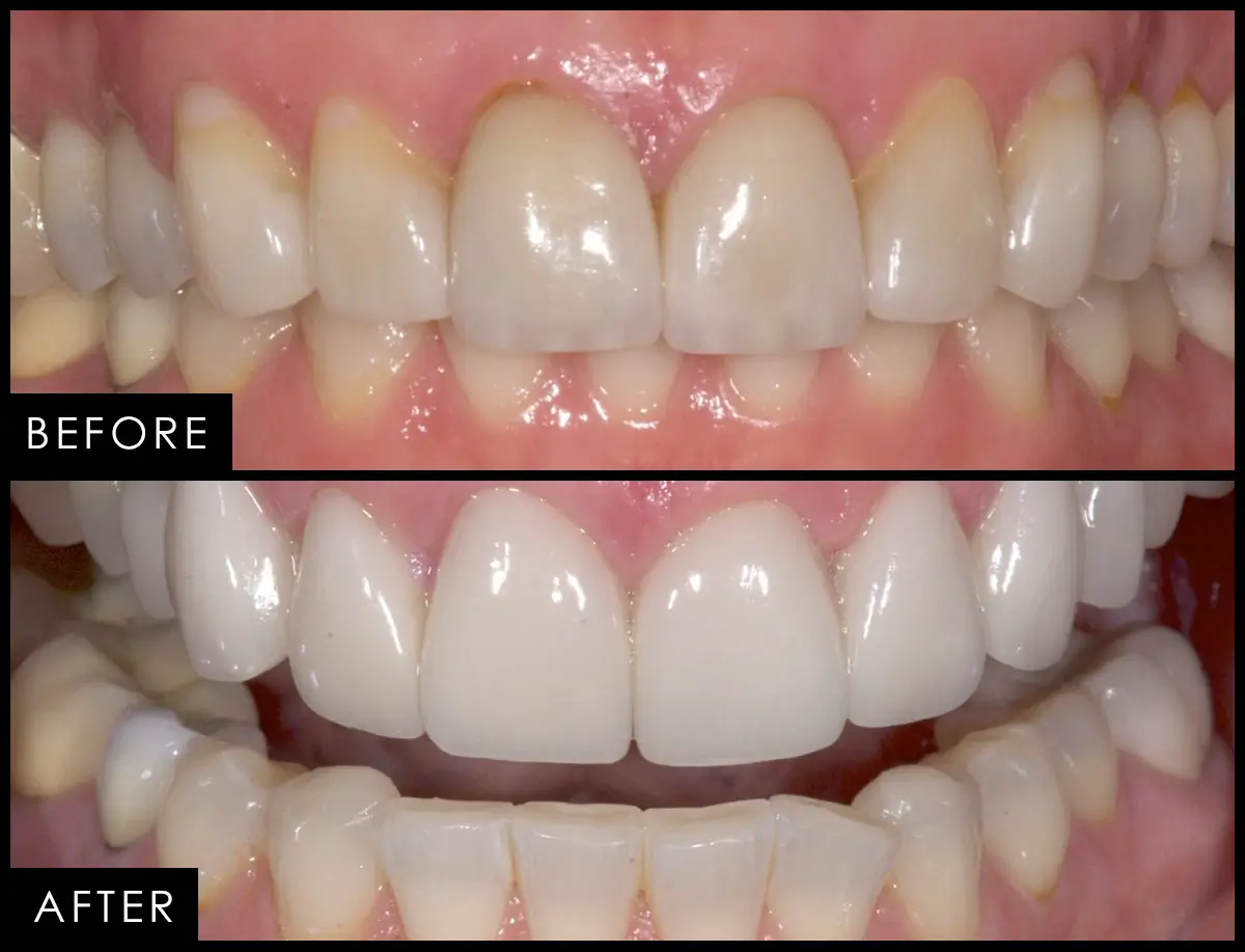 Before and after