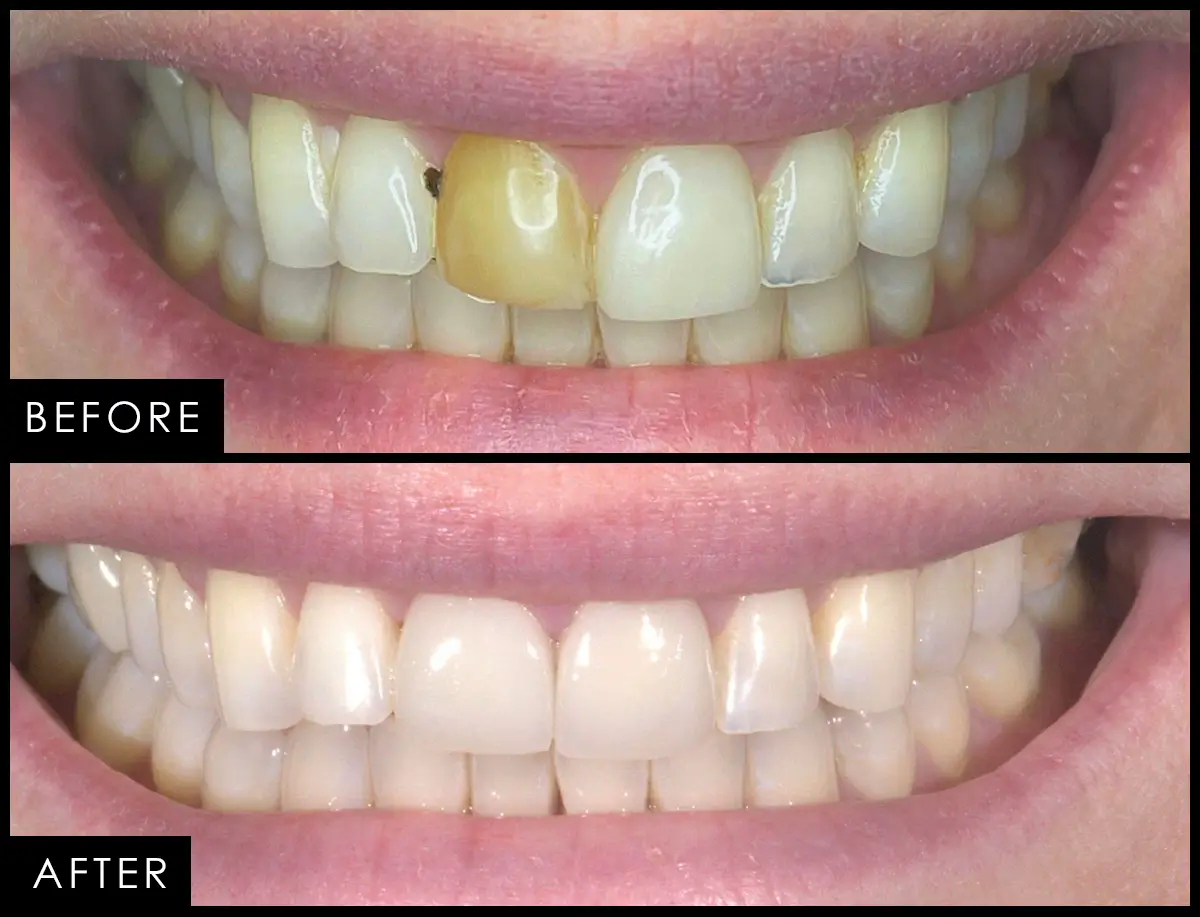 Before and after