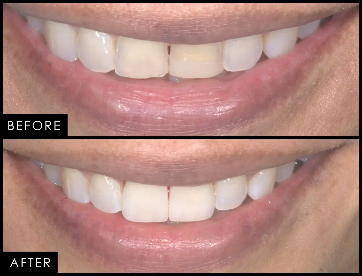 Before and after