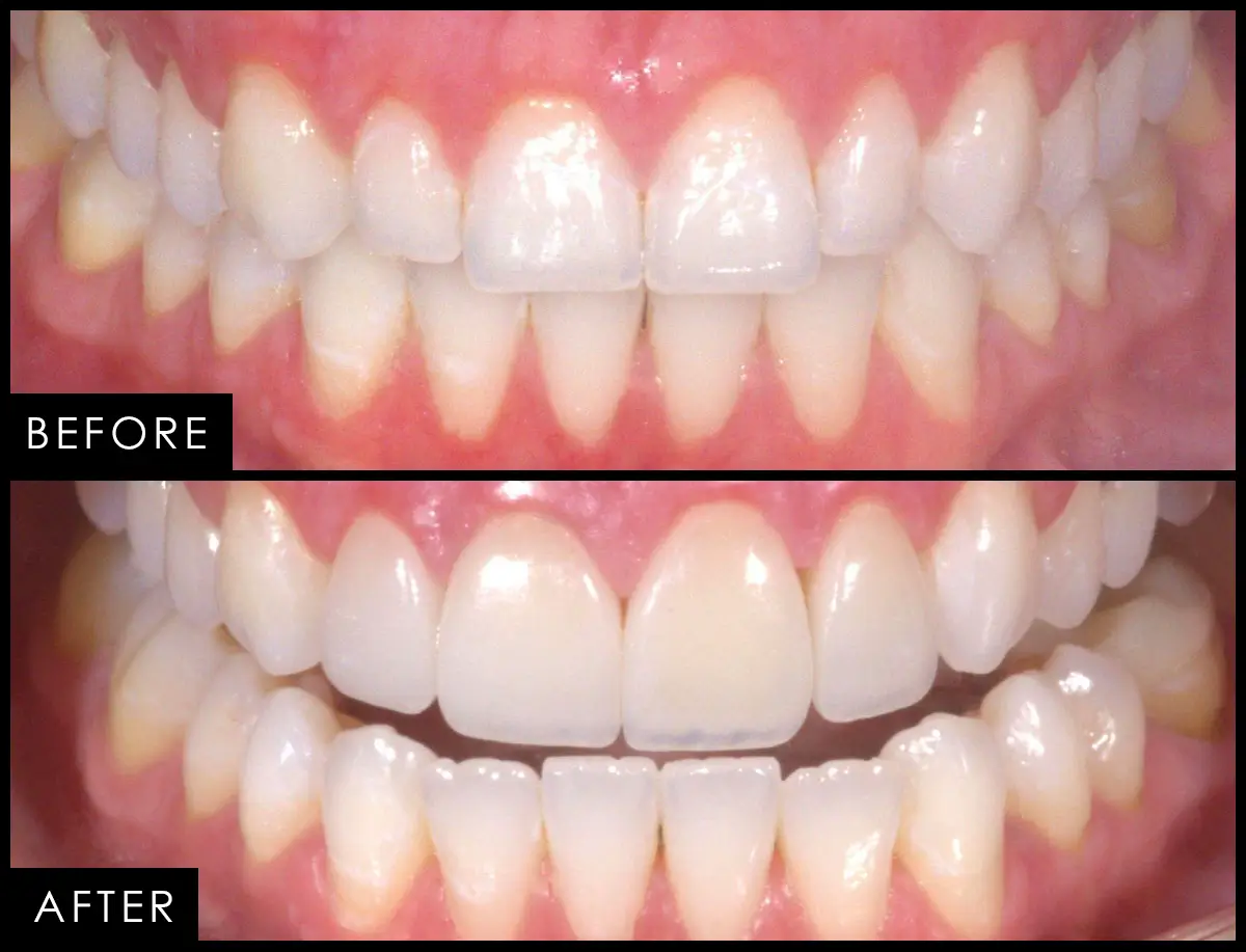 Before and after